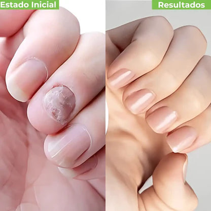 FUNGAL NAIL PATCHES - PARCHES ANTIHONGOS DE RENOVACIÓN PROFUNDA